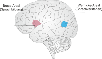 broca Aphasie